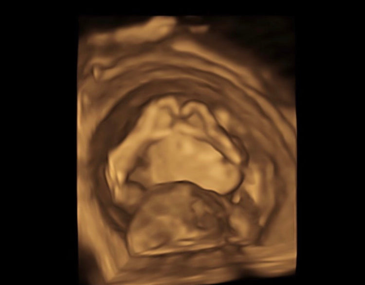 First Glance Ultrasound - Deposit Paid